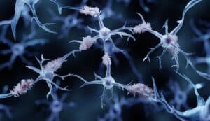 Alzheimer 1
